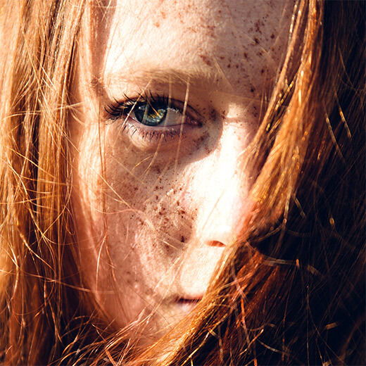 does the sun help acne