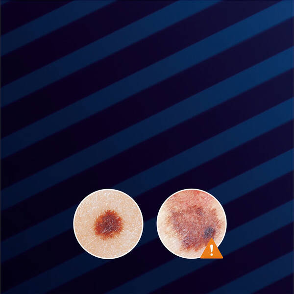 Two close-up images of skin lesions on a dark blue striped background. The left lesion appears as a small, brown spot, while the right shows a larger, irregular brown spot with an exclamation mark icon indicating caution.
