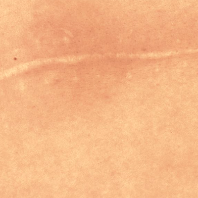 Scarring: Mastering Massage Techniques