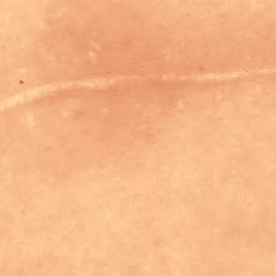 Scarring: Mastering Massage Techniques
