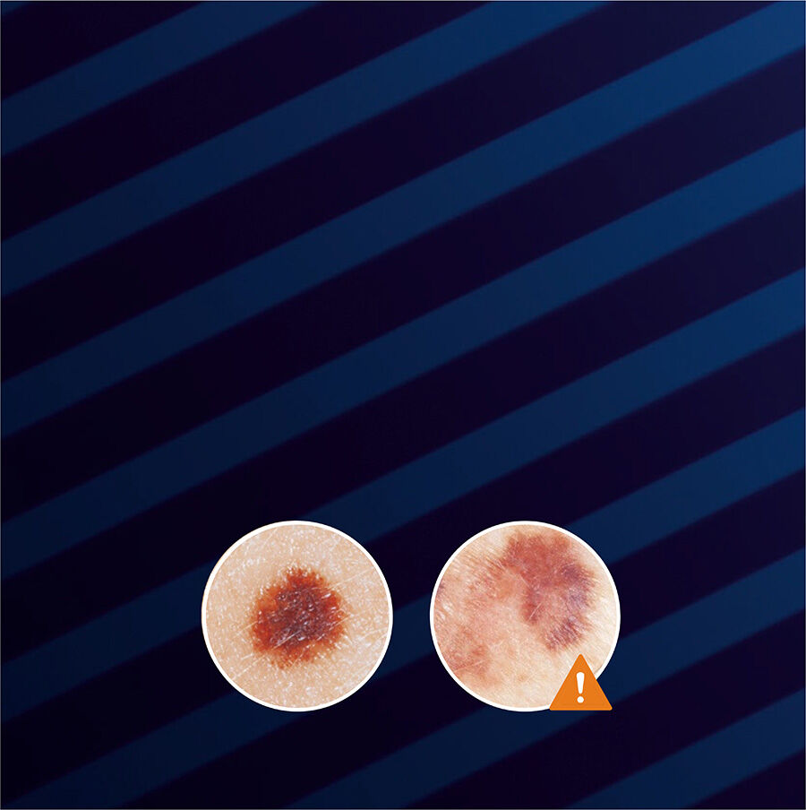 Image shows two close-up views of skin lesions, with one lesion indicated by an orange warning triangle to suggest caution or concern. The background features dark blue diagonal stripes.