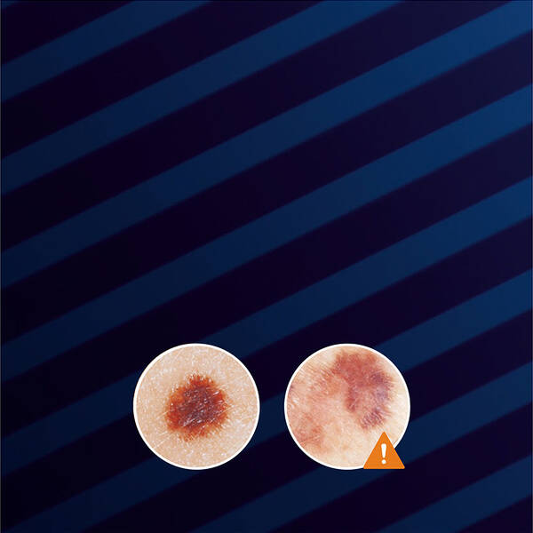 Image shows two close-up views of skin lesions, with one lesion indicated by an orange warning triangle to suggest caution or concern. The background features dark blue diagonal stripes.