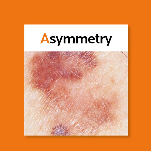 A graphic displaying five close-up images of skin lesions, labeled with the ABCDE guide for identifying potential skin cancers: Asymmetry, Borders, Colour, Diameter, and Evolution. The background is orange.