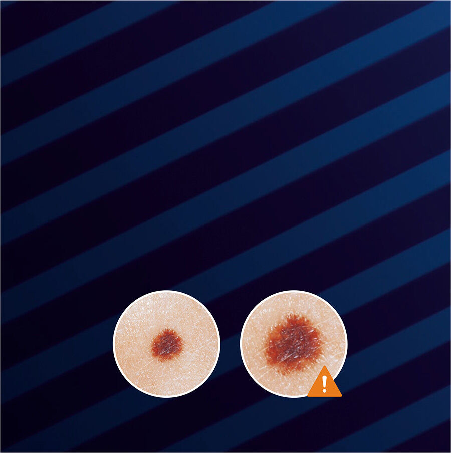 Two circular skin images on a dark background, one with a brownish spot in the center. An exclamation mark indicates a warning or concern about the spot's appearance.