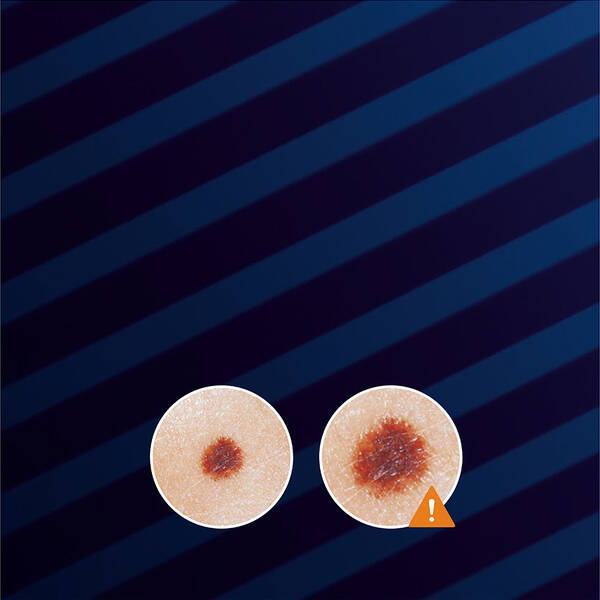 Two circular skin images on a dark background, one with a brownish spot in the center. An exclamation mark indicates a warning or concern about the spot's appearance.