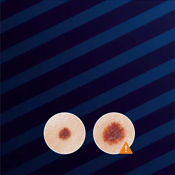 Two circular skin images on a dark background, one with a brownish spot in the center. An exclamation mark indicates a warning or concern about the spot's appearance.