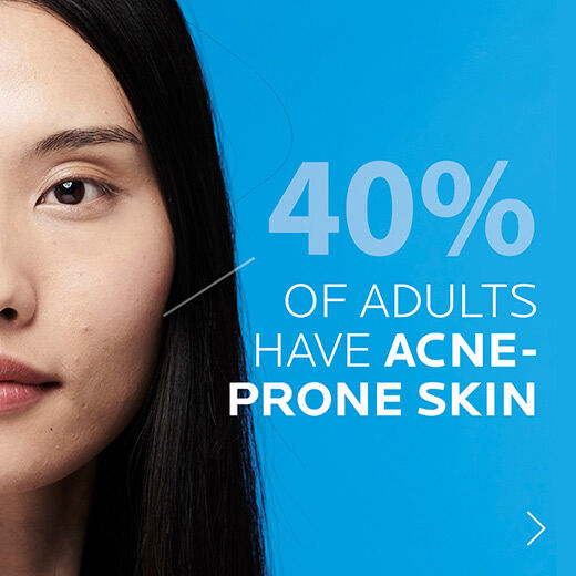 Close-up of a woman's face with black hair, accompanied by text stating "40% of adults have acne-prone skin" on a blue background.