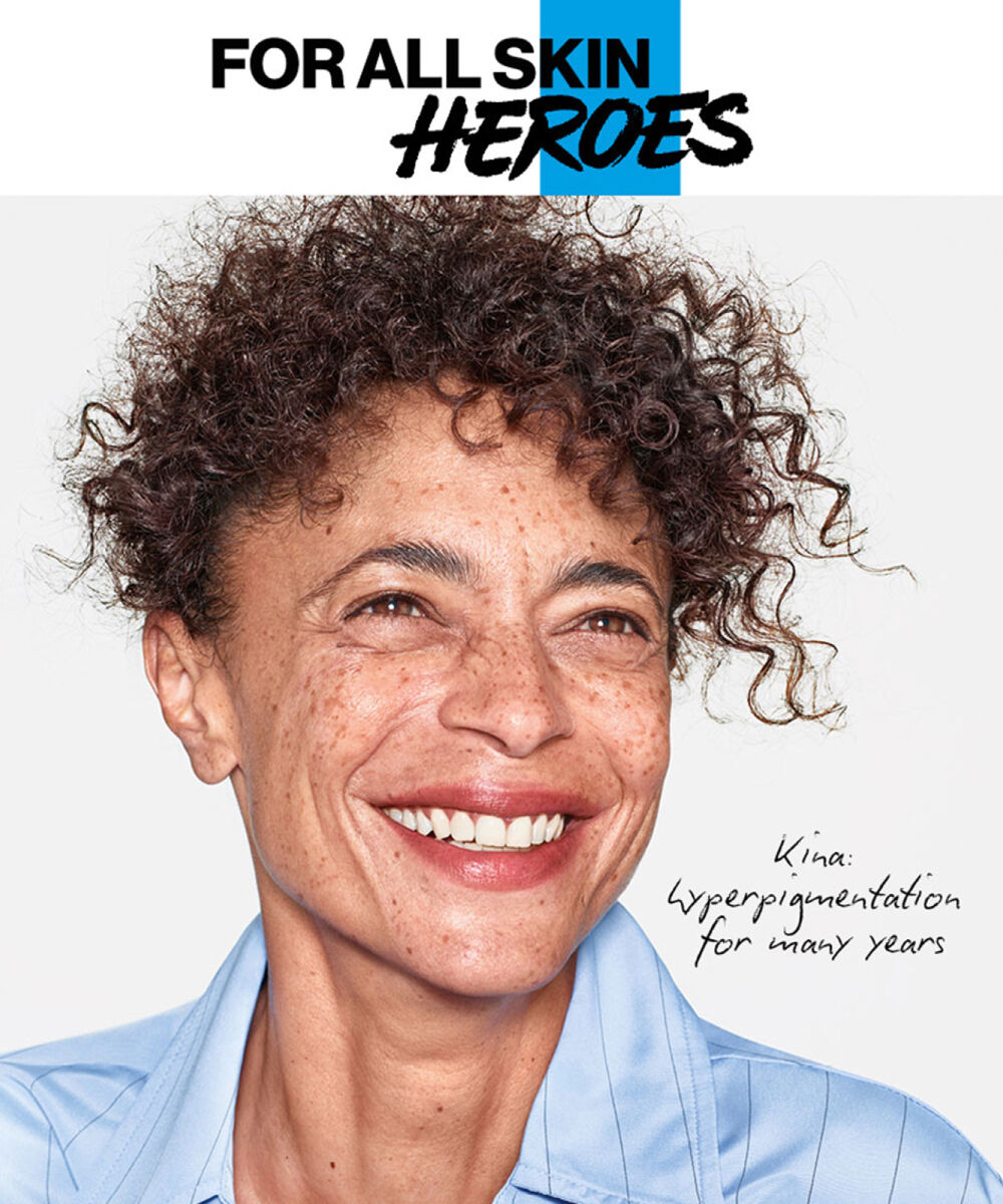 Kina has had hyperpigmentation for many years