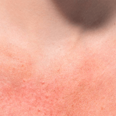 Sun Protection: Protect Your Skin From UV Rays