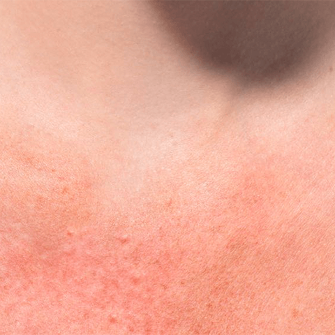 Sun Protection: Protect Your Skin From UV Rays