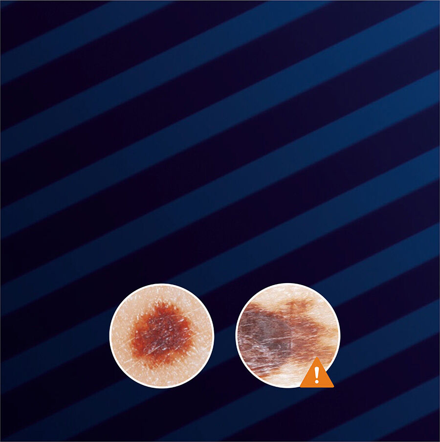 Two close-up images of a skin lesion displayed on a dark blue striped background. The right image features an orange warning symbol, indicating concern or the need for further examination.