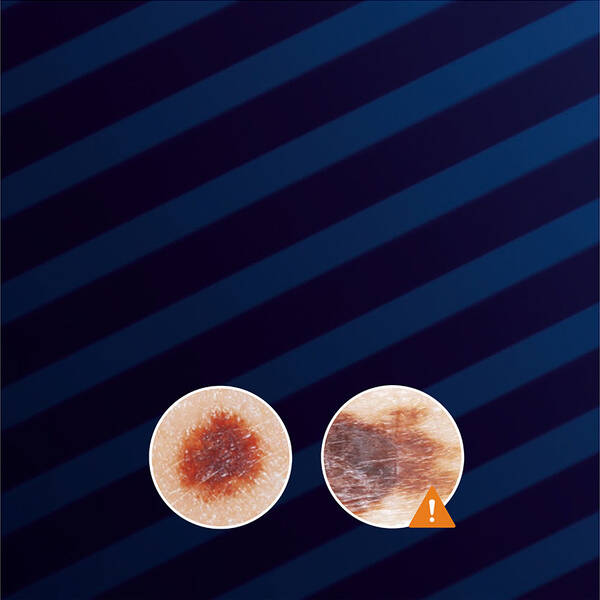 Two close-up images of a skin lesion displayed on a dark blue striped background. The right image features an orange warning symbol, indicating concern or the need for further examination.