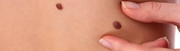 Sun awareness - moles