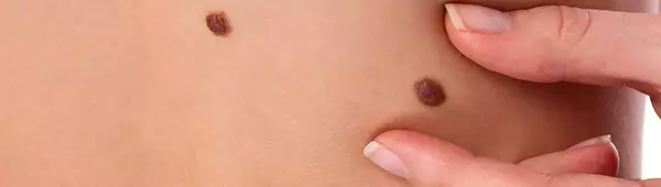Sun awareness - moles