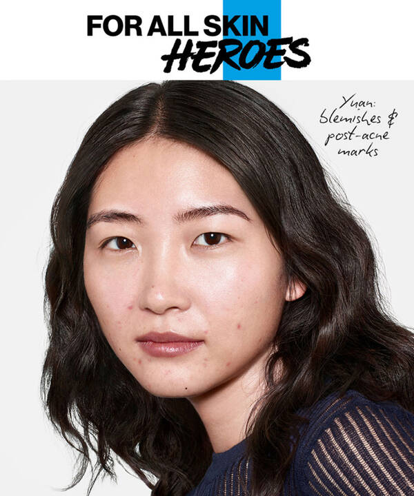 Yuan, has blemishes and post-acne marks